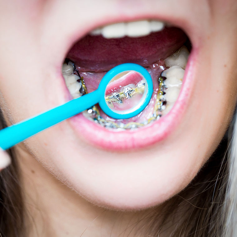 Benefits of lingual braces