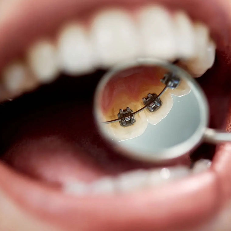 What are lingual braces?