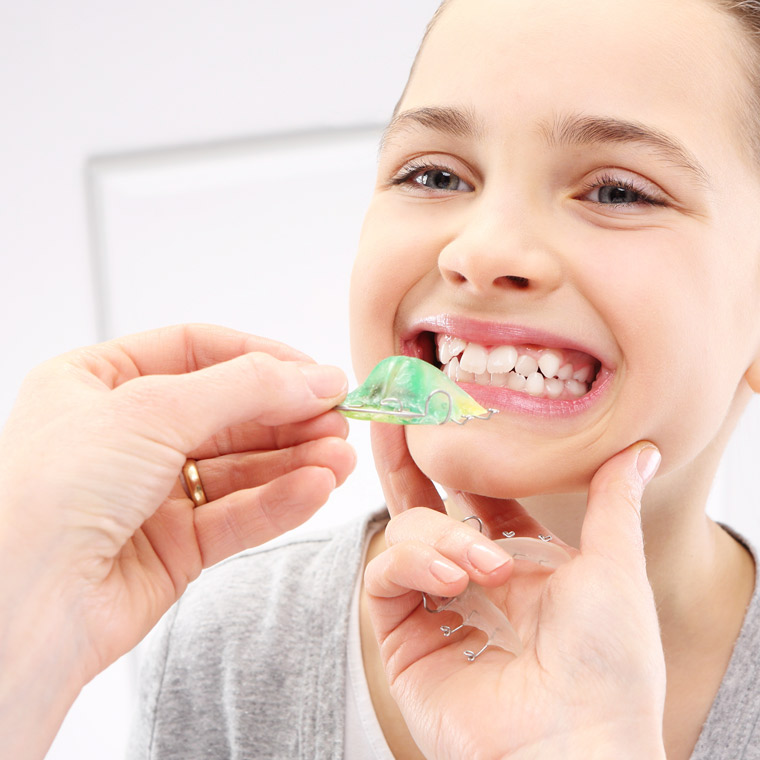 What are Upper Removable Braces?