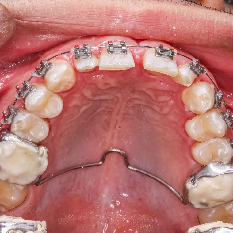 How does the Beneslider work?