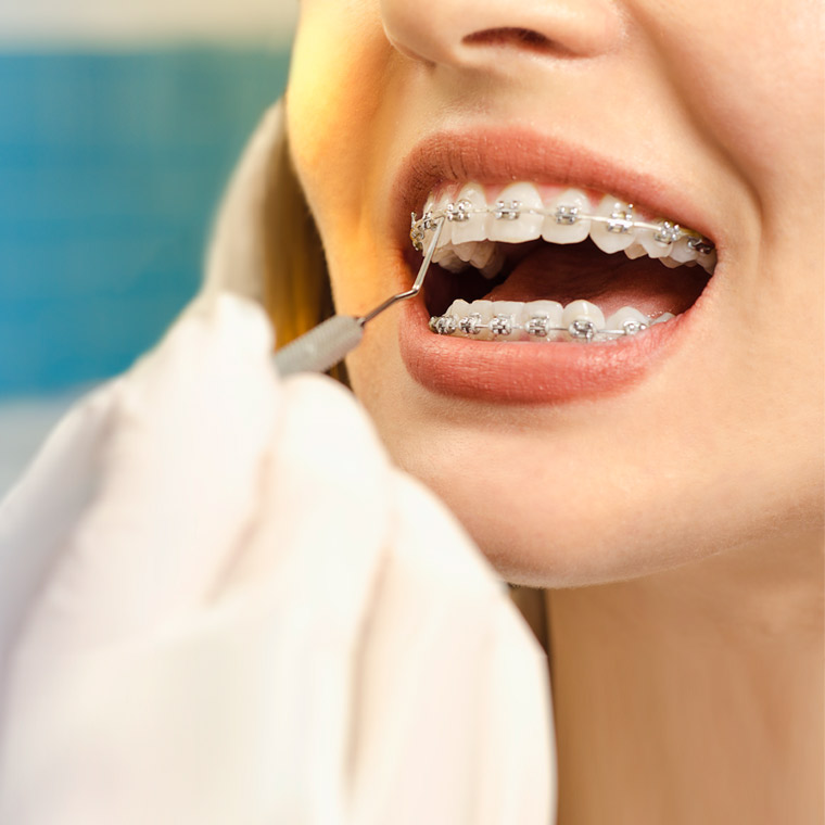 Alternatives to Twin Block braces