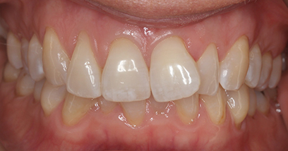 Before & Afters