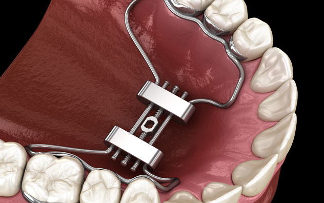 Miniscrew-Assisted Rapid Palatal Expansion (MARPE)