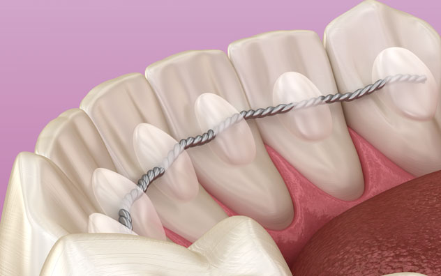 Fixed retainers