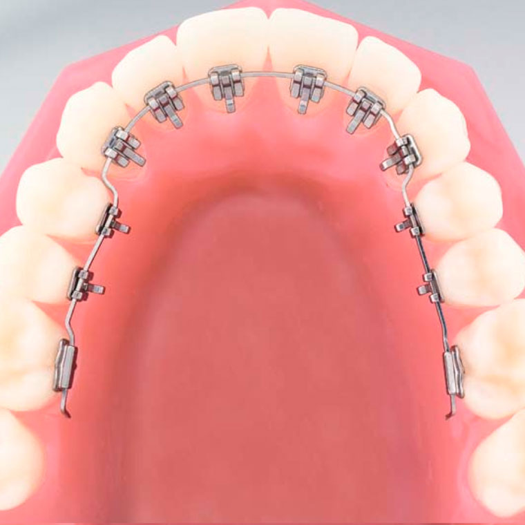 Lingual-Braces.jpg