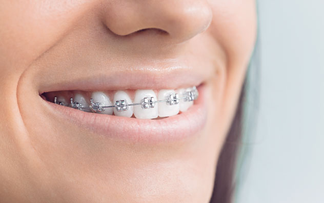 Metal braces