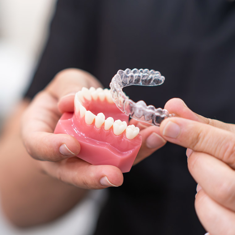 Angel Aligners vs Other Clear Aligner Systems