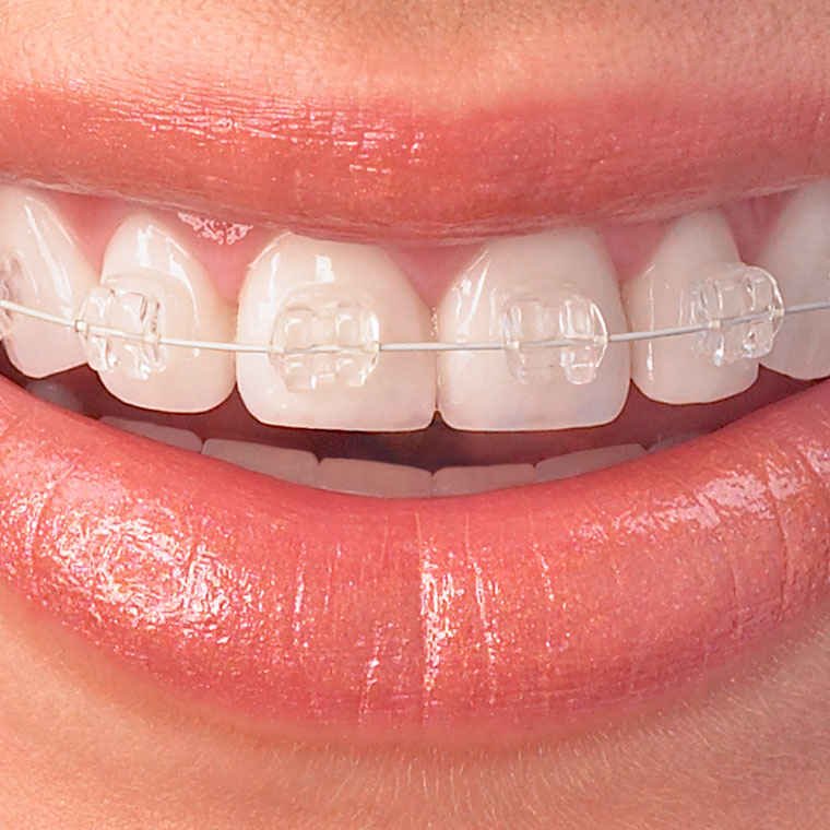 ceramic-braces.jpg