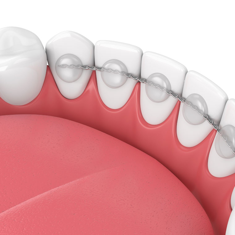 What is a fixed retainer?