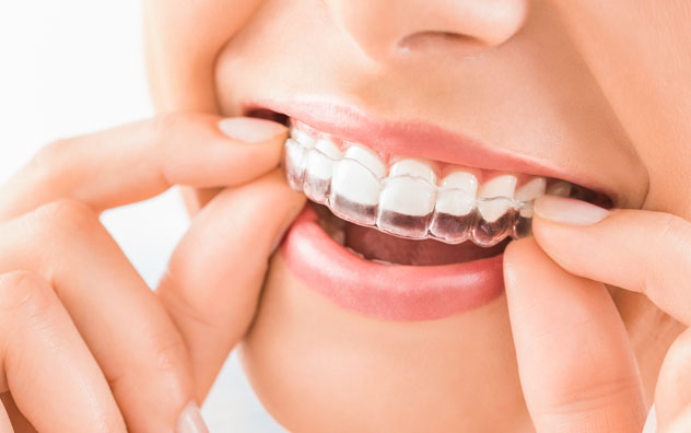 Essix retainers