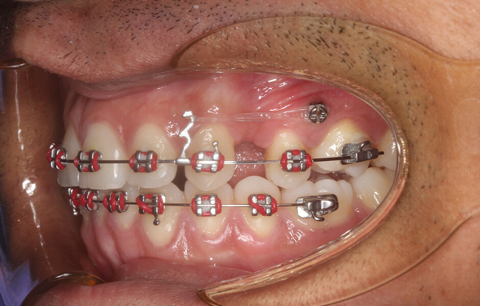 Temporary anchorage devices (TADs)