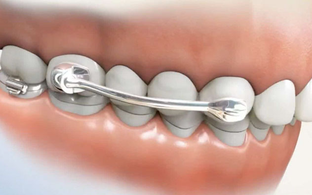 Functional Braces