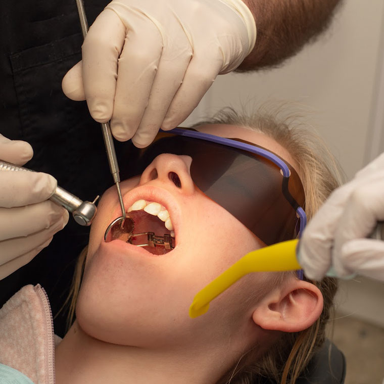 How does the palatal expander work?