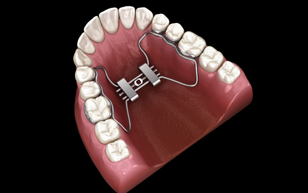 Rapid Palatal Expansion (RPE)