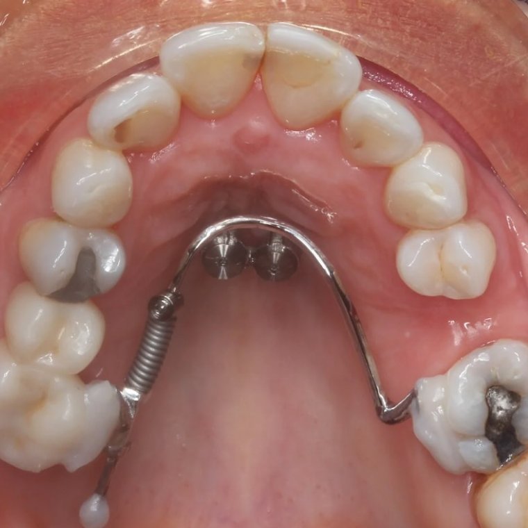 What is Rapid Palatal Expansion?