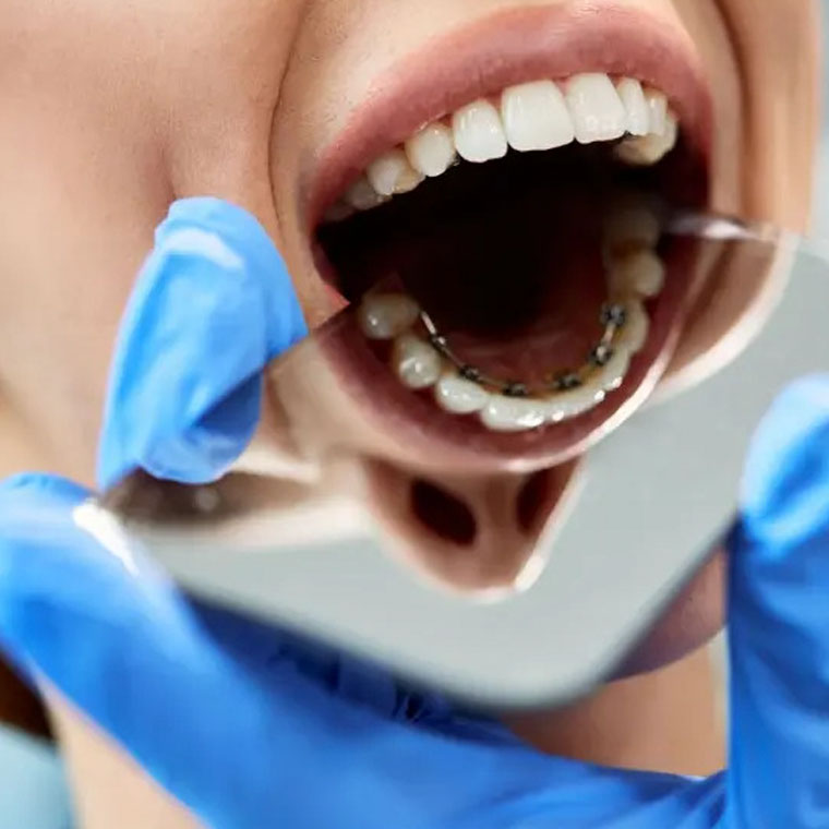 How long do lingual braces take?