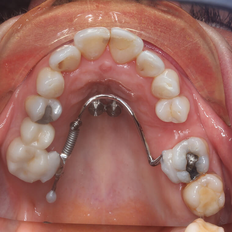 Why do we use the Beneslider?
