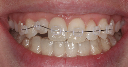 Before & Afters