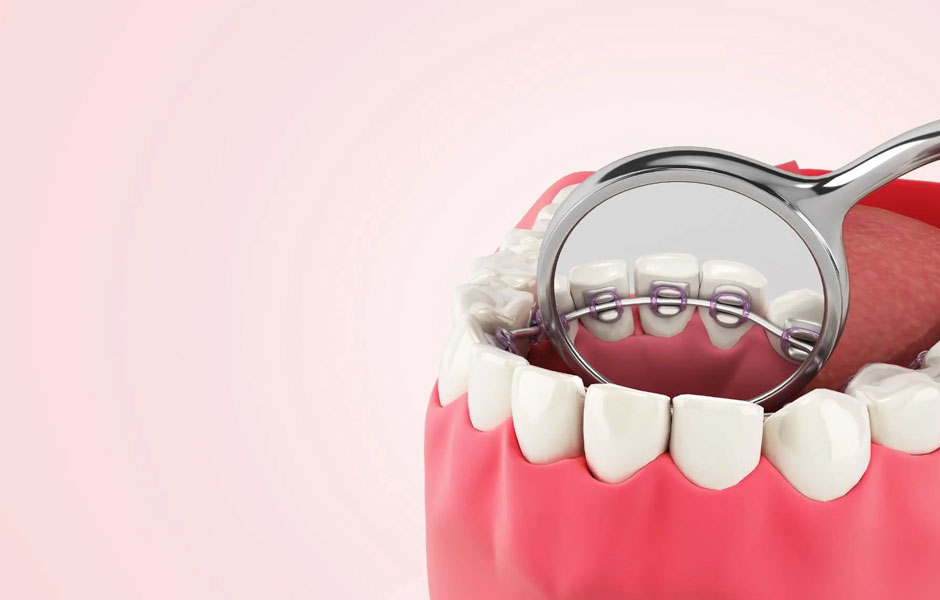 Lingual braces Lingual braces