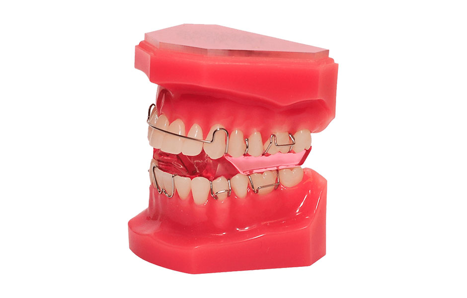 Twin Blocks Treatment Twin Blocks Treatment