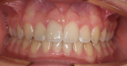 Before & Afters