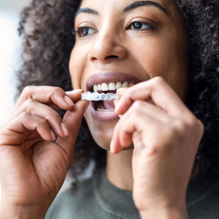 Benefits of an Essix retainer